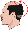 Hair Transplant